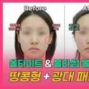 볼패임 다양한 원인 피부 리프팅 부작용 볼살 찌는 법 이미지