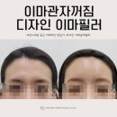 미샤인의원 | 관자놀이필러 후기 : 꺼진 얼굴 윤곽을 매끄럽게 개선하는 비결
