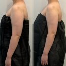 세븐일레븐 광명티타워점 | 광명 신부관리 에스테틱 ‘키히뷰티’ 팔뚝 관리 슬림핏 관리후기