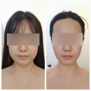 금곡동 피부관리 _쁨뷰티(피부) 얼굴 윤곽 관리 후기