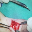 MASTER the Modified Kessler tendon repair IN JUST 2 MINUTES! 이미지