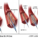 뇌경색 - 스텐트 시술 후 혈관이 넓혀졌는데 왜 약을 복용하는지? 이미지