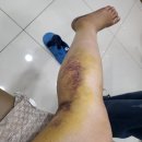 클라이밍하다 야간진료하는 한사랑정형외과에서 정강이뼈 골절 수술 후기, 입원, 주차