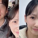 메트로필 | 연신내 귀필러 요정귀 큐티필 대만족 후기