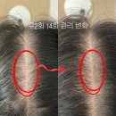 (주)현토탈솔루션 | 해운대탈모관리 가벼워진 정수리 고민해결 (고객님 전후 리얼 후기)