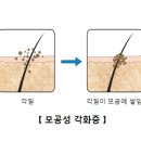 모공성 각화증(Keratosis pilaris) 피부질환이란? 이미지