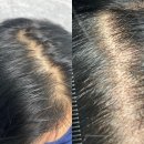 4679 | 청량리탈모커버 · 청량리숱채움 전문 [동대문/청량리] 뉴데이 후기