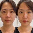 자야뷰티(JAYA Beauty) | 알라비다 뷰티패치 3개월 내돈내산 찐 후기와 가격 할인 꿀팁 공개!