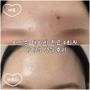 대구여드름한의원 골드PTT 고주파니들 VSM 한달 후기 피부 변화 기록