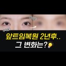 메이트성형외과 | 메이트성형외과 앞트임복원 장기경과 후기