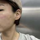 피부과 연어주사, 리쥬란 효과 전후 솔직 후기! + 통증, 가격