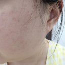 대구 다이어트병원 복부 지방분해주사 1회차 관리 가격 효과 솔직 후기