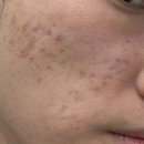 셀라스 | 여드름파인흉터 시술 셀라스레이저 후기 강남피부과전문의 가격