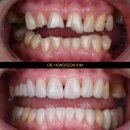 세렉밀링센터 치과기공소 | 이수역 치과 라미네이트 삭제량 걱정된다면? 0.3mm의 미학 '리본라미'로 리버스 에이징