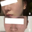 경기도 수원시 영통구 매탄로79번길 | [수원피부관리/예쁜아침] 홍조 피부에 좋은 물방울 관리 1회차 솔직 후기