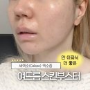 화장품일번지 - 상주시 남성로 51 | 여드름 스킨부스터 피부과 트러블관리 세렉소(Celexo) 엑소좀 후기 / 안 아픈 시술