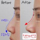 어울림성형외과의원 | 직반버선코라인 , 여성스러움과 자연스러움의 끝판왕🔥⭐