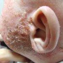 Atopy Is Liver Disease - Breastfeed Baby Atopy 이미지