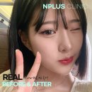 짧은코수술후기 잘 어울리는 라인으로