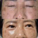 구로-구로-구로-1612 | 뷰티스킨케어 개봉동본점 : 60대 엄마 리프팅 후기 + 전후사진 첨부