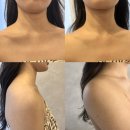 5893 | [해운대웨딩관리] 예쁜 어깨라인을 위한 승모근관리 후기 <올스스 라운지 마린시티본점>