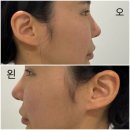 내돈내산코재수술후기강남압구정브라운성형외과한달차코수술잘하는곳만족해요추천