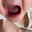 명이치과의원 | [육아기록] 13개월아기 넘어지면서 잇몸출혈, 춘천 365시에스치과 진료후기!