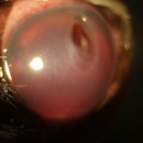 Deep C. Ulcer 이미지
