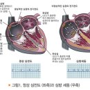 심방세동과 뇌졸중(腦卒中) 이미지