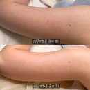 씨유 인천힐스본점 | 부평 피부관리샵 ‘월영에스테틱’에서 모공각화증 팔 관리받고 온 후기✨예신관리 추천