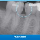 충치 단계에 따른 치료 비용 대구 닥터손치과보철과