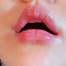 비오비의원 | 2021년4월16일 마지막후기(리터치2일)(리터치1일째)(7일째)(5일째 움짤)(4일째추가)부산 입꼬리보턱스...