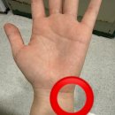 1) 손목 통증 치료 후기, TFCC 손상 부분파열 치료