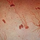 장티푸스[typhoid fever] 이미지