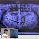 망포우리약국 | 일상_내 인생 첫 매복 사랑니 발치 후기, 발치 후 통증, 실밥 제거