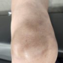 운동하고 연골주사 맞았어요 이미지