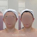 가을 에스테틱 | 천안 웨딩관리 가을팀장님 케이엠에스테틱 성형 윤곽 후기