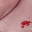 삼성제일약국 | 강북삼성병원 신생아 혈관종 치료 후기 ① : 혈관종 원인, 치료, 검사, 비용 등