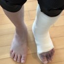 청구목욕탕 | 불편해서 오픈캐스트 깁스로 바꾼 내돈내산 후기 (중족골 골절, 깁스하고 목욕탕가기, 실비보험 청구하기)