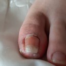 엔스타네일 | 내성발톱으로 생고생 리얼 버라이어티 후기