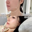 얼굴 | 부산피부과 올타이트리프팅 효과 쳐진 얼굴 내돈내산 솔직 후기