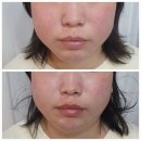 탑스뷰티 | 인천 서구 탑스뷰티 - 엑스터 Ester 프락셔널 레이저, 맞춤형 피부관리후기