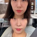 닥터손유나의원 캣주사 2회차 디테일 후기