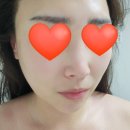 석전동204 | 마산에스테틱 마산피부관리 합성동피부관리 모리에스테틱 물방울리프팅 후기