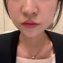 글로우미 | 화명동피부과 미글로우 후기 온다리프팅 비교 심부볼처짐 라인관리 리프팅