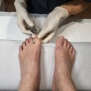 리브스테 | 오블리브의원/균뿌리프락셀 발톱무좀은 아톰레이저로 치료하기
