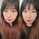 차이남 | [지방이식 후기] 앞광대+팔자 수술 후 전후비교, 부기, 부작용...