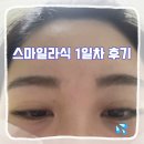 [스마일라식 1일차] 스마일라식 하고 온 생생한 후기