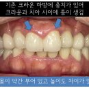 씌운 앞니에서 냄새가 나요 (앞니 원데이 임플란트 )
