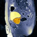 ​전립선 비대증 증상: 알아둬야 할 주요 정보 이미지